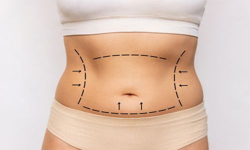 After Tummy Tuck Surgery 3