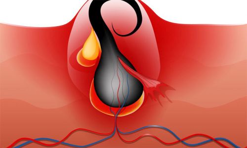 Pilonidal Sinüs Nedir 3