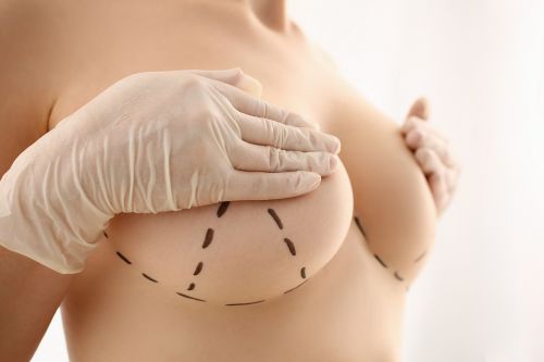 Breast Augmentation Surgery 2