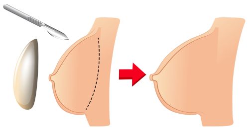 Breast Augmentation Surgery