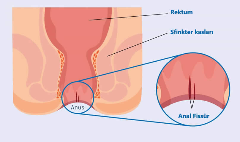 Anal Fissür (Makat Yırtığı) Ameliyatı